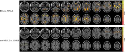 Structural and Functional Characterization of Gray Matter Alterations in Female Patients With Neuropsychiatric Systemic Lupus